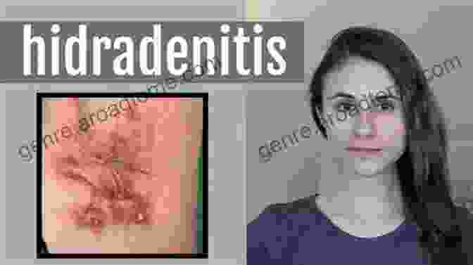 A Photo Of A Person With Hidradenitis Suppurativa The Of Hidradenitis Suppurativa A Field Guide For Surviving And Overcoming Hidradenitis Suppurativa: Skin Disease