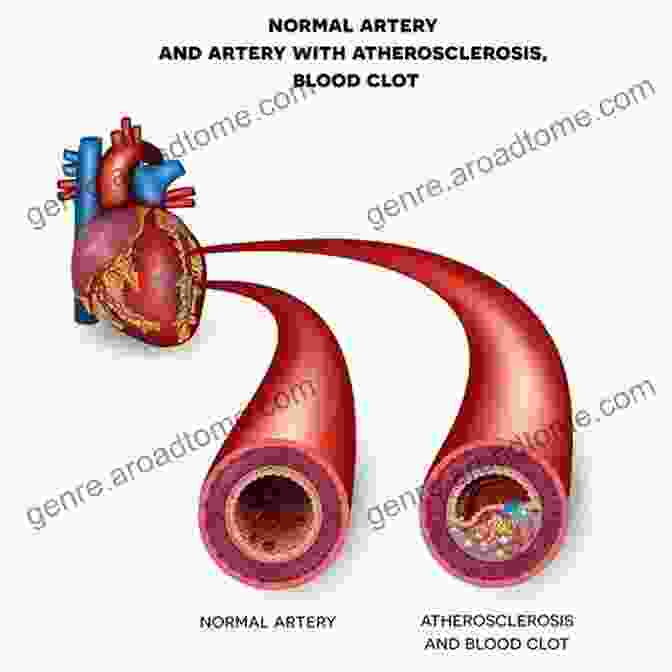 Diagram Of A Clogged Artery REMOVE BAD CHOLESTEROL NATURALLY REDUCE CLOGGED ARTERIES AND STROKE: 10 FOODS THAT UNCLOG ARTERIES NATURALLY AND PREVENT HEART ATTACK