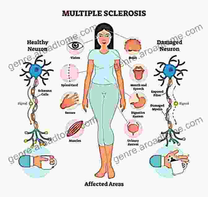 Electromagnetic Pollution Multiple Sclerosis Symptoms And Causes Electromagnetic Pollution: Multiple Sclerosis Symptoms And Causes