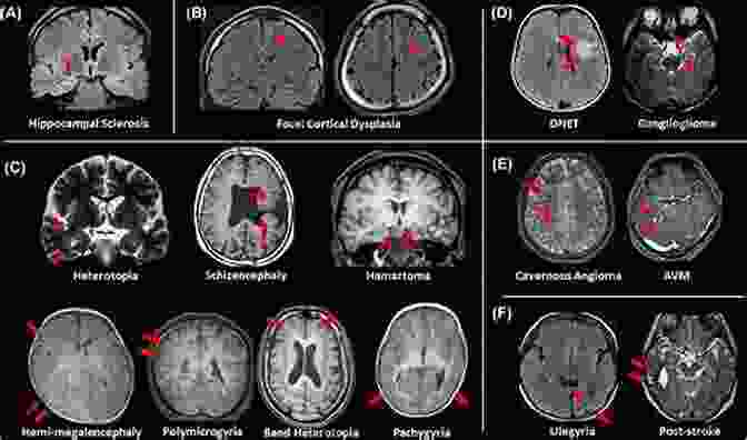 MRI Scan Of An Epileptic Brain Invasive Studies Of The Human Epileptic Brain: Principles And Practice