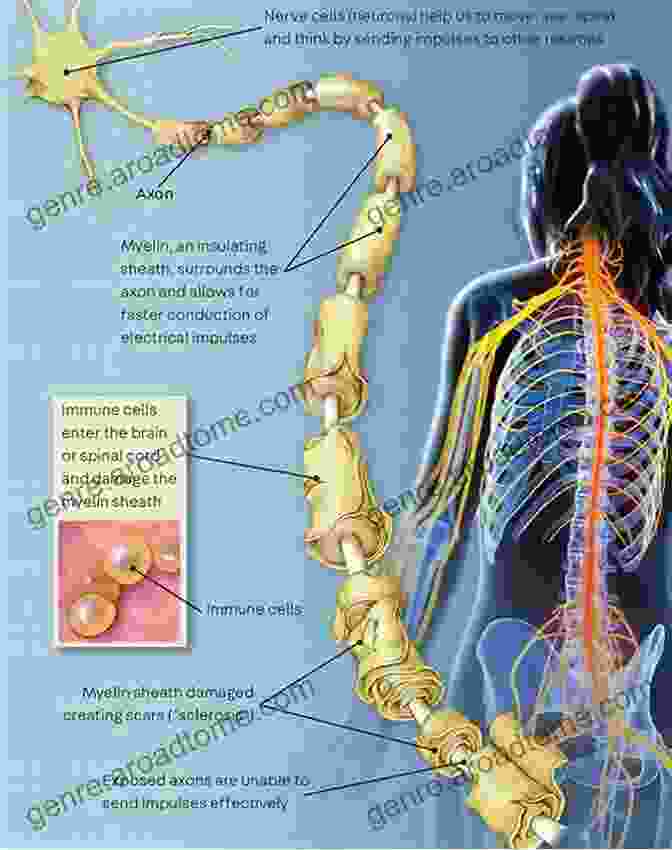 Multiple Sclerosis Affects The Brain And Spinal Cord. Treat Multiple Sclerosis: Multiple Sclerosis Management